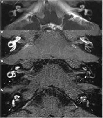 Comparison between audio-vestibular findings and contrast-enhanced MRI of inner ear in patients with unilateral Ménière’s disease